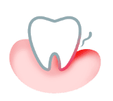 مشاكل اللثة المتقدمة