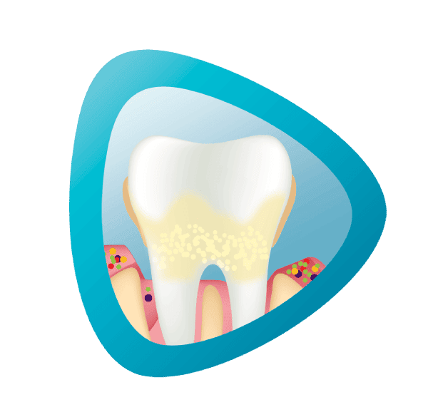 مشاكل اللثة المتقدمة