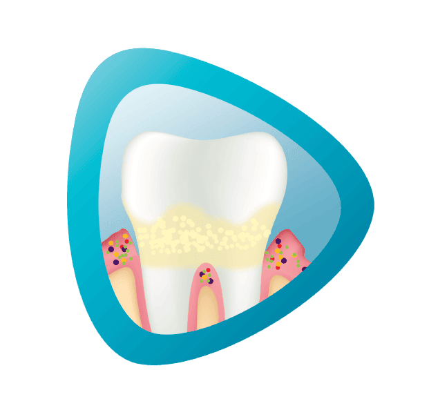 مشاكل اللثة