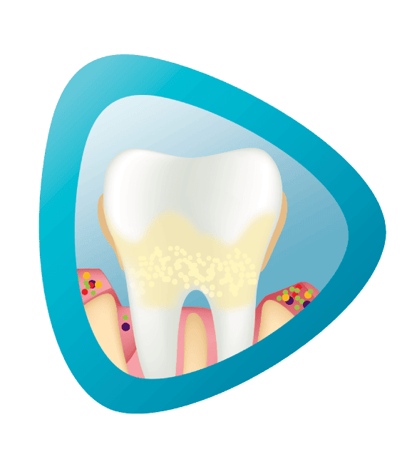 مشاكل اللثة المتقدمة